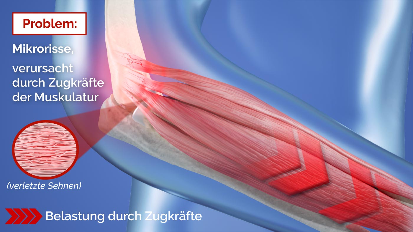 Illustration, wie Zugkräfte die Epicondylitis verursachen